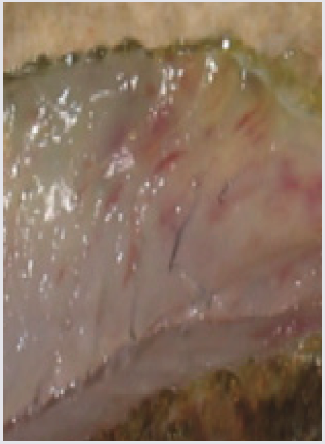 Hemorrhagic Areas In Muscle Tissue